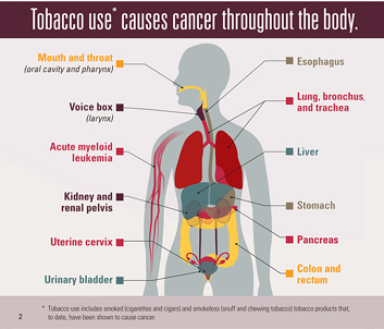 p1110-cancer-tobacco_353px Infographic: Tobacco use* causes cancer throughout the body